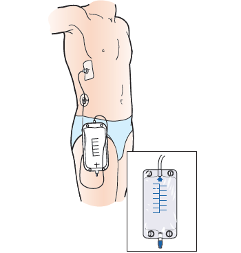 Figure 11. Drainage bag below the catheter