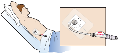 Figure 13. Capped biliary drainage catheter