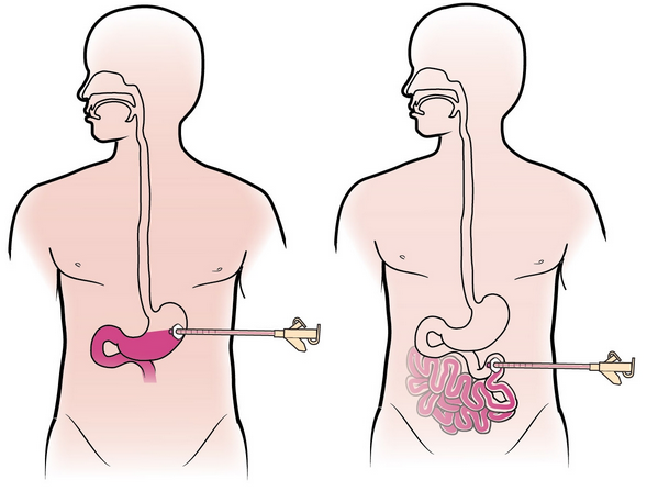 About The Placement Of Your Percutaneous Endoscopic Gastrostomy PEG