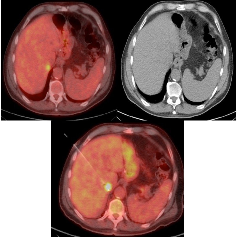 pet-guided-biopsies-memorial-sloan-kettering-cancer-center