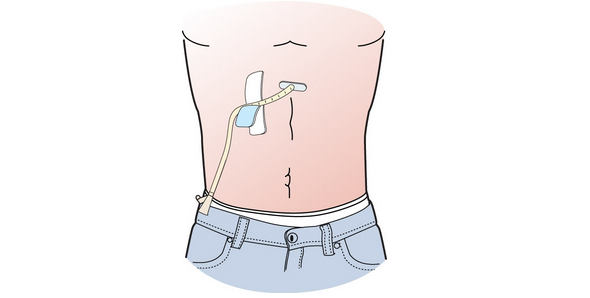 About The Placement Of Your Percutaneous Endoscopic Gastrostomy (PEG ...