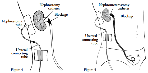 Caring For Your Nephrostomy Catheter Memorial Sloan Kettering Cancer