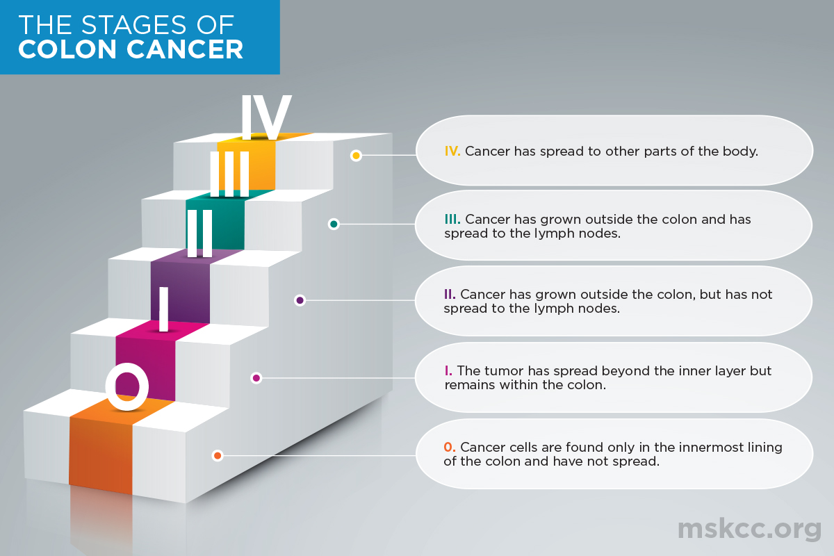Stages 0, 1, 2, 3, 4 of Colon Cancer