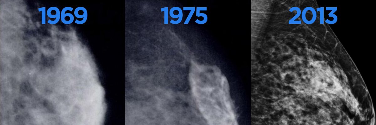 Mammograms And Other Types Of Breast Exams Memorial Sloan Kettering Cancer Center