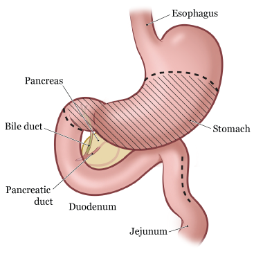 Subtotal Gastrectomy Diet After Surgery