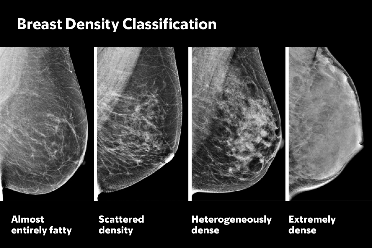 Mammograms of different breast densities.