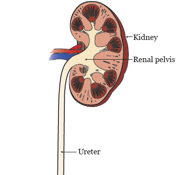 About Your Nephrostomy Catheter | Memorial Sloan Kettering Cancer Center