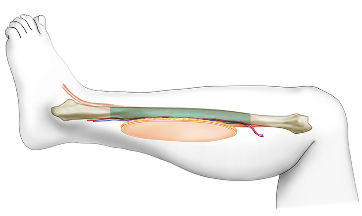 Fibula Free Flap Mandibular Reconstruction