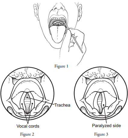 Vocal Cord Paralysis | Memorial Sloan Kettering Cancer Center