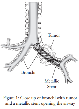 Tracheal or Bronchial Stent Placement | Memorial Sloan Kettering Cancer ...