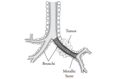 Tracheal or Bronchial Stent Placement | Memorial Sloan Kettering Cancer ...