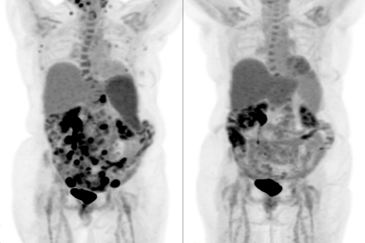 Side-by-side PET scans of a torso