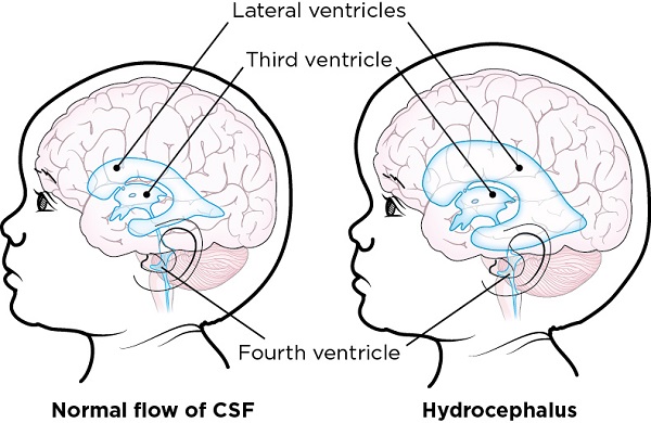 Hydrocephalus Vs Normal Brain