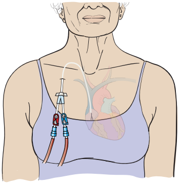 About Your Dialysis Treatment | Memorial Sloan Kettering Cancer Center