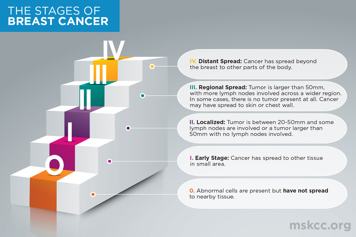 Breast Cancer Stages 0, 1, 2, 3 and 4