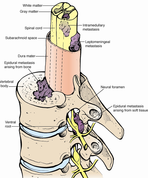 Spine Tumors & Spinal Cancer | Memorial Sloan Kettering Cancer Center