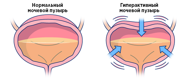 Рисунок 1.  Нормальный мочевой пузырь (слева) и гиперактивный мочевой пузырь (справа)