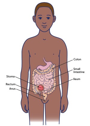 Figure 1. An ileostomy
