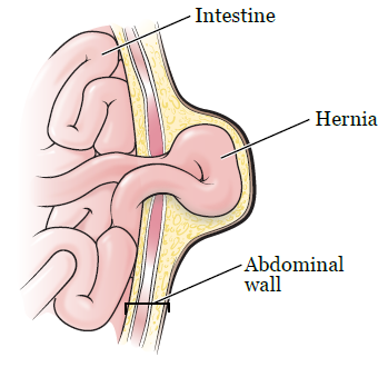 Figure 2. An abdominal incisional hernia