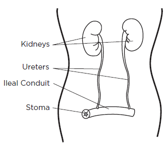 Ileal Conduit Anatomy