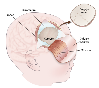 Figura 1. Cirugía para extirpar el tumor cerebral