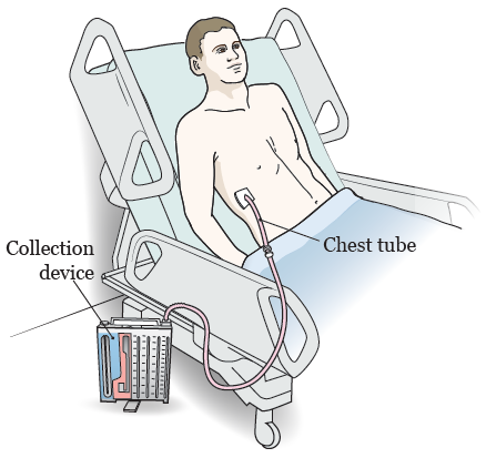 About Your Chest Tube Placement Procedure