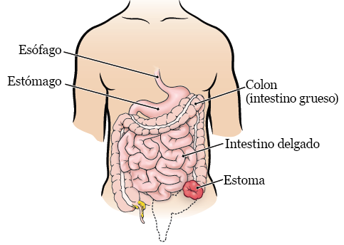 Figura 2. Estoma de colostomía