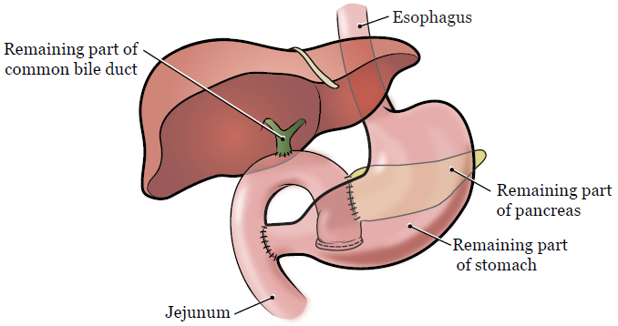 图 2. 术后的胰腺及周围器官