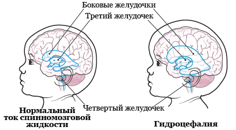 Рисунок 1.  Головной мозг с гидроцефалией и без нее