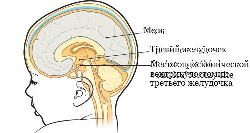 Рисунок 2.&nbsp; Место эндоскопической вентрикулостомии третьего желудочка (ETV)