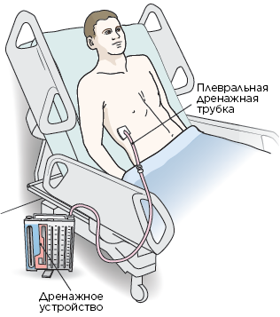 Рисунок 13.  Плевральная дренажная трубка с дренажным устройством