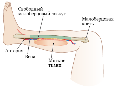 Рисунок 1.  Свободный малоберцовый лоскут