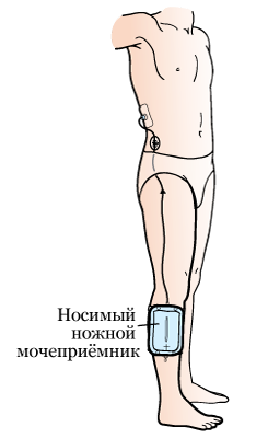 Несостоятельность нефростомы карта вызова