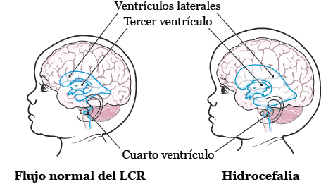 Figura 1. Cerebro con y sin hidrocefalia