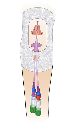 Figure 2. PICC with SecurAcath and Tegaderm dressing