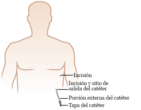 Figura 3. Catéter PleurX