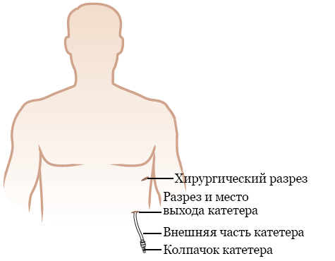 Рисунок 3.  Катетер PleurX