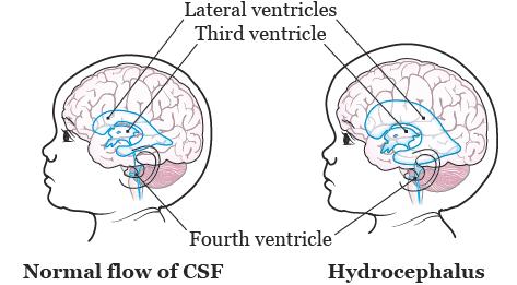 About Your Ventriculoperitoneal (VP) Shunt Surgery for Pediatric Patients