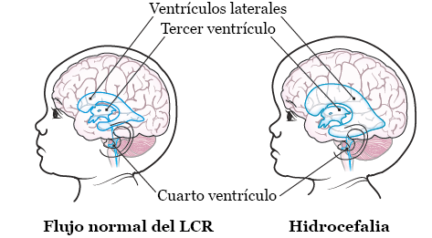 Figura 1. Cerebro con y sin hidrocefalia