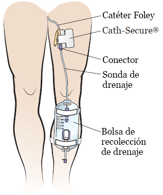 Figura 3. Catéter urinario (Foley)