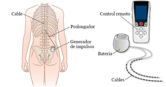 Figura 1.&nbsp;Partes del estimulador de la médula espinal