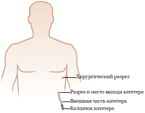 Рисунок 9.  Катетер для дренирования плевральной полости