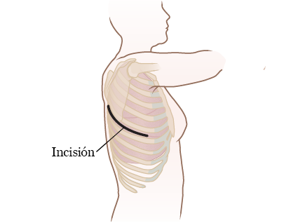 Figura 10. Incisión de toracotomía