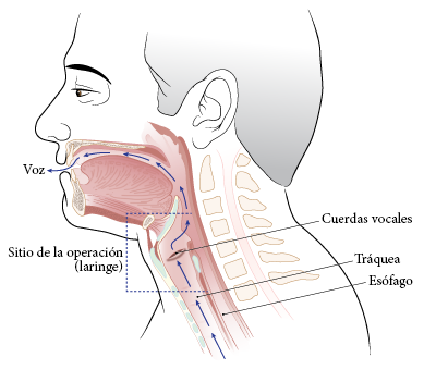 Figura 1. Antes de la laringectomía