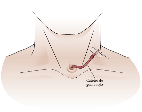 Figura 11. Sujeción del catéter al cuello con una cinta