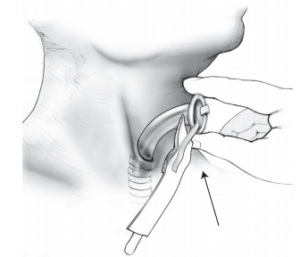 Рисунок 3.  Введение ларингэктомической трубки