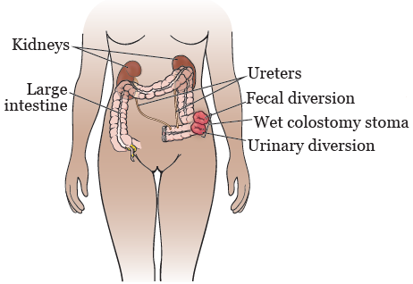 Urinary Stoma Catheterization - YouTube