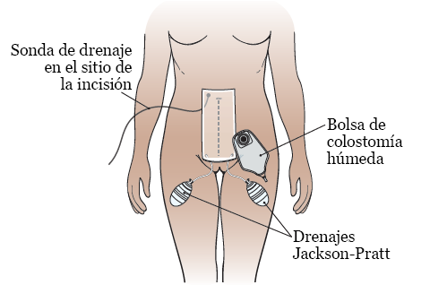 Figura 5. Drenajes, bolsa y tiritas después de su cirugía
