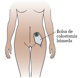Figura&nbsp;7. La bolsa de colostomía húmeda