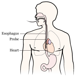 Figure 1. A transesophageal echocardiogram (TEE)